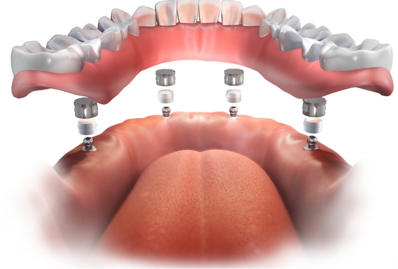 all-on-4 dental implant