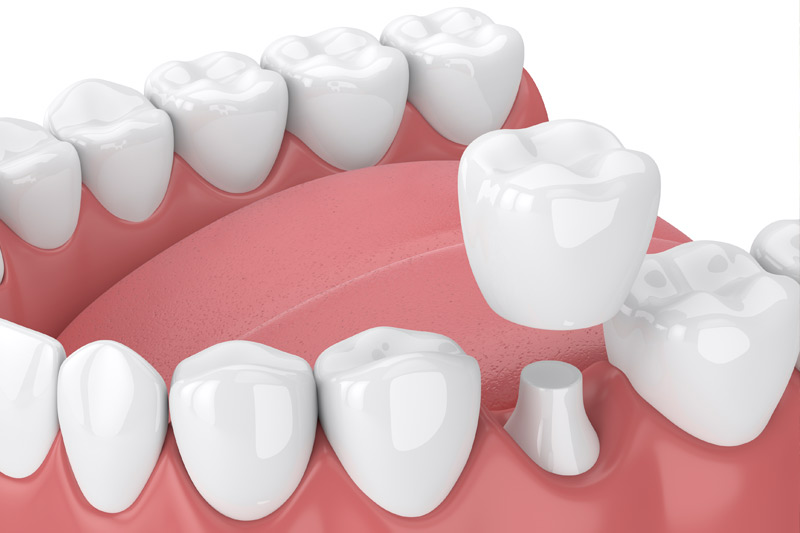 Quality Dental Treatments in West Jordan