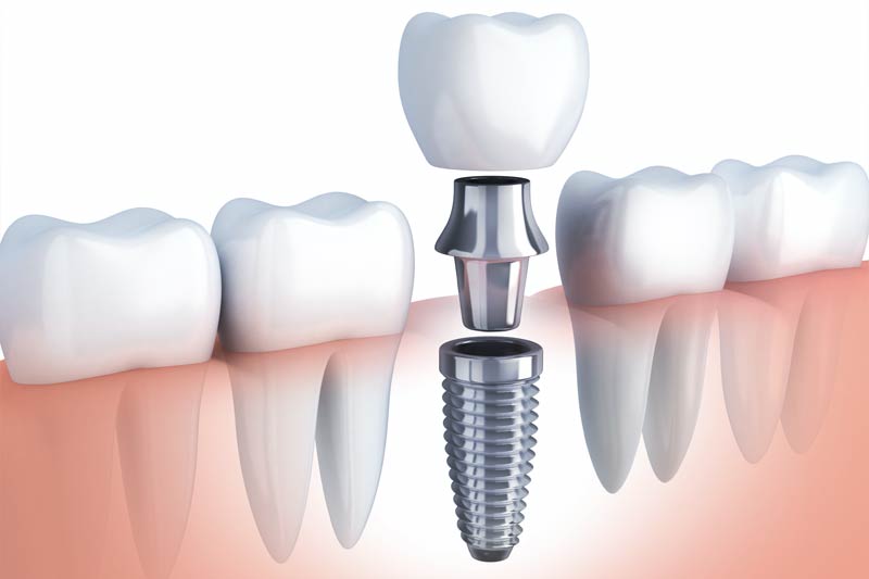 Implants Dentist in West Jordan