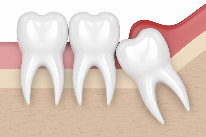 Wisdom Tooth Removal in West Jordan